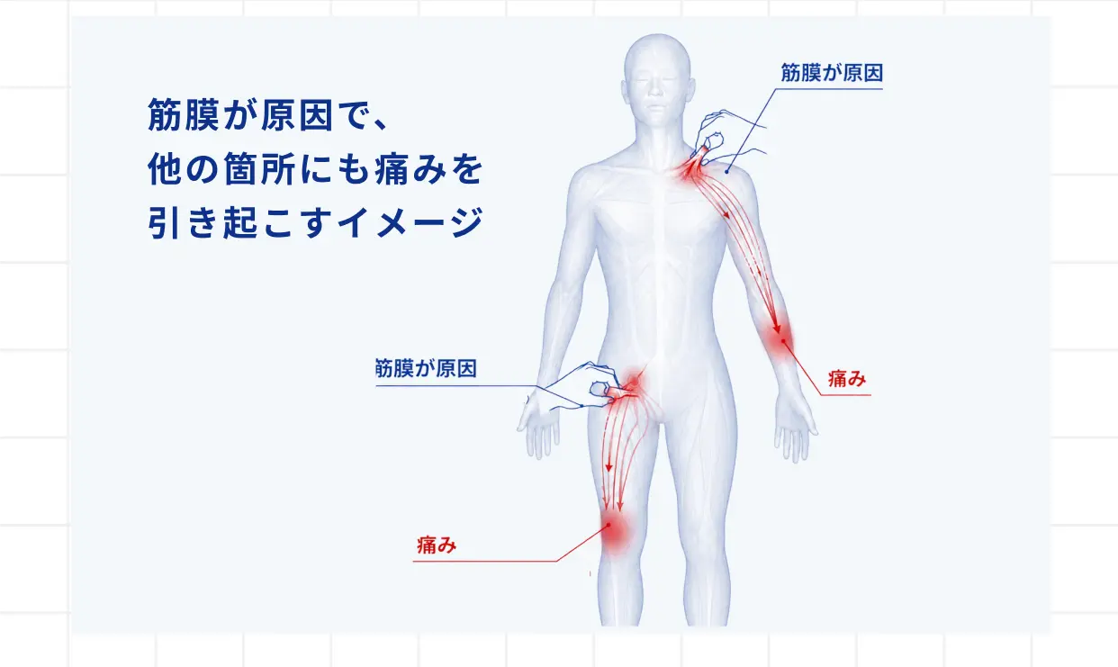 筋膜が原因で、他の箇所にも痛みを引き起こすイメージ 筋膜が原因 痛み 筋膜が原因 痛み